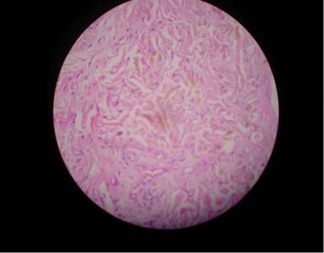 OCRONOSIS - HISTOPATOLOGIA - DR. PIQUERO