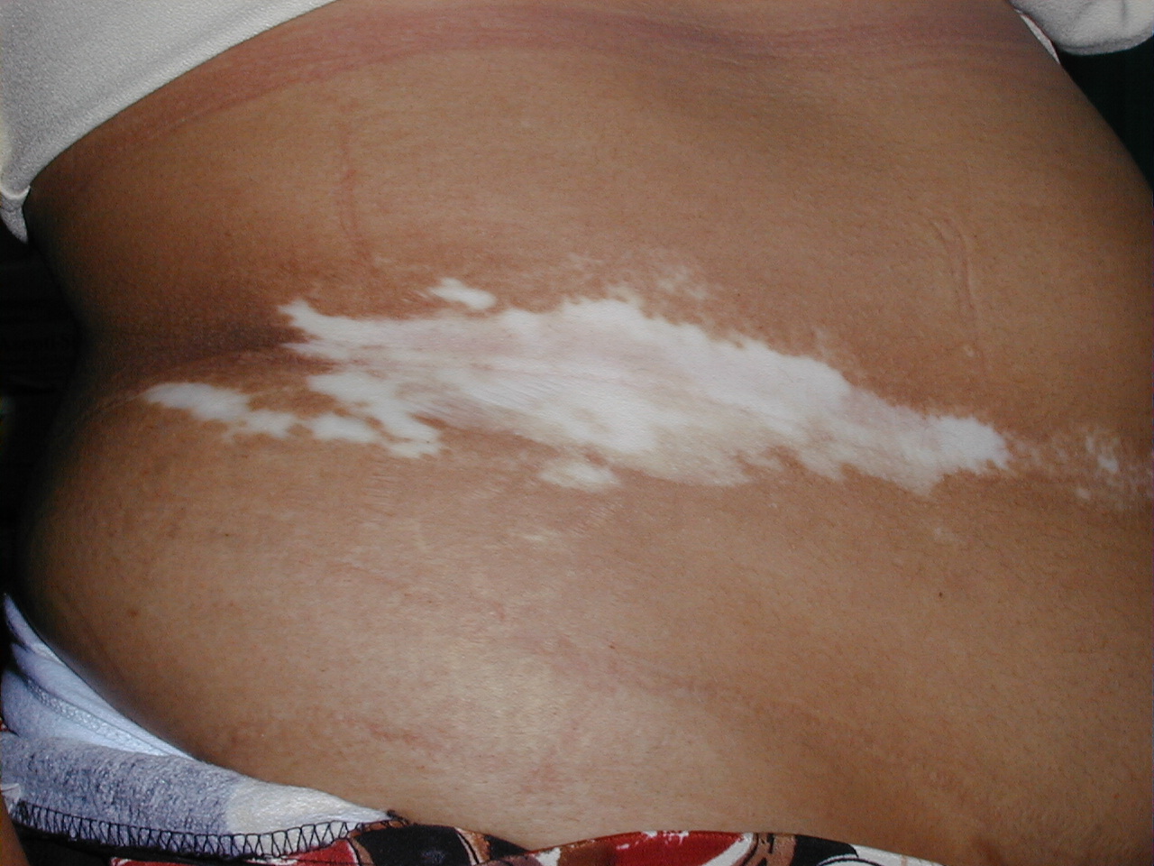 VITILIGO