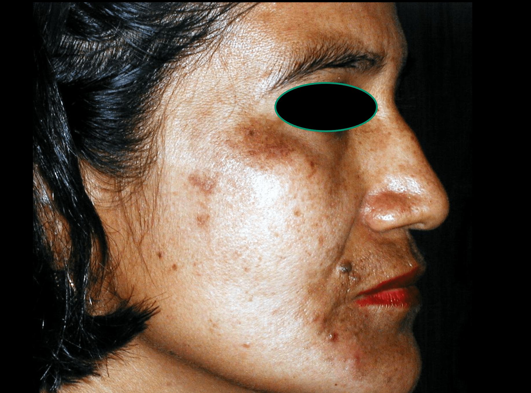 MELASMA