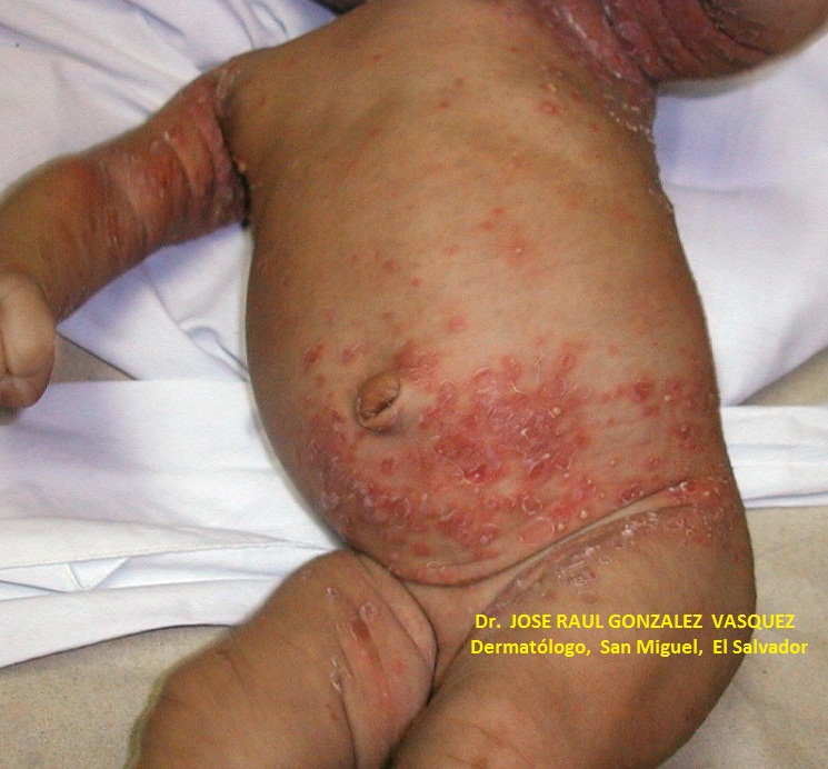 ESCABIOSIS - IMPETIGO