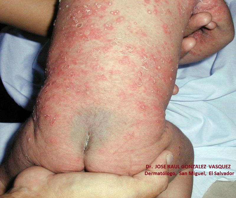 ESCABIOSIS - IMPETIGO