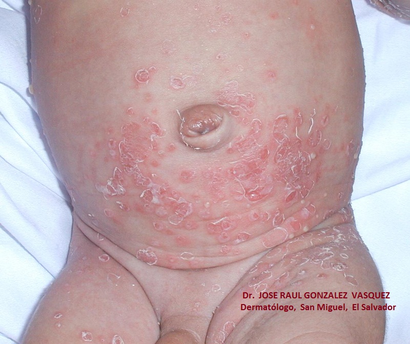 ESCABIOSIS - IMPETIGO