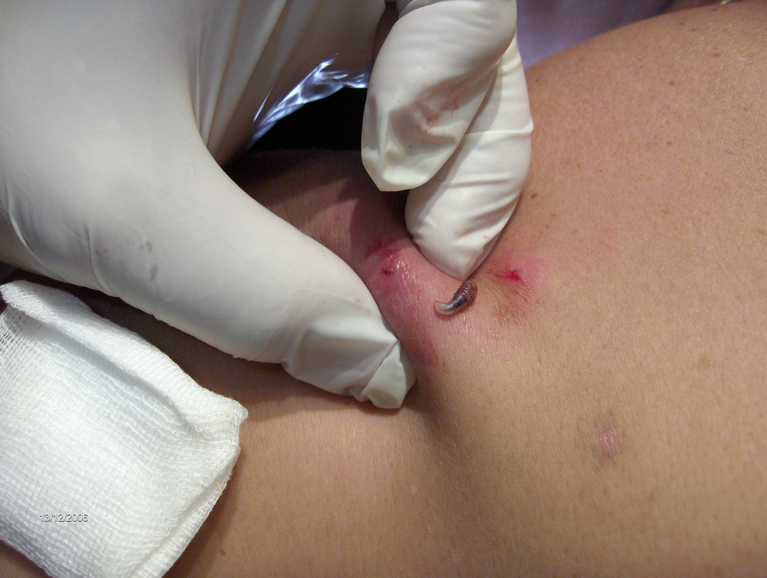 TORSALO - EXTRACCION DE LARVA