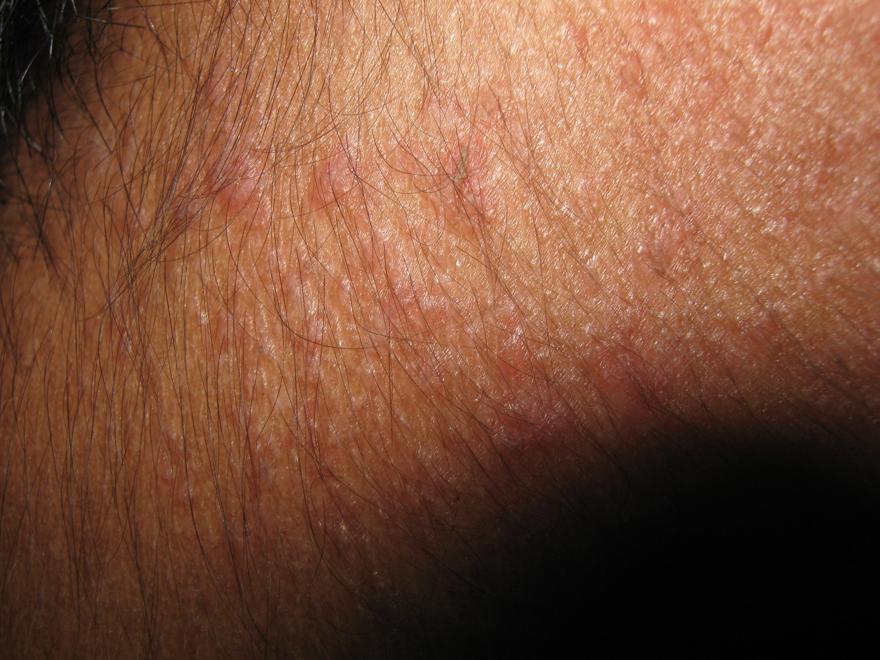 ENFEREMEDAD DE DARIER