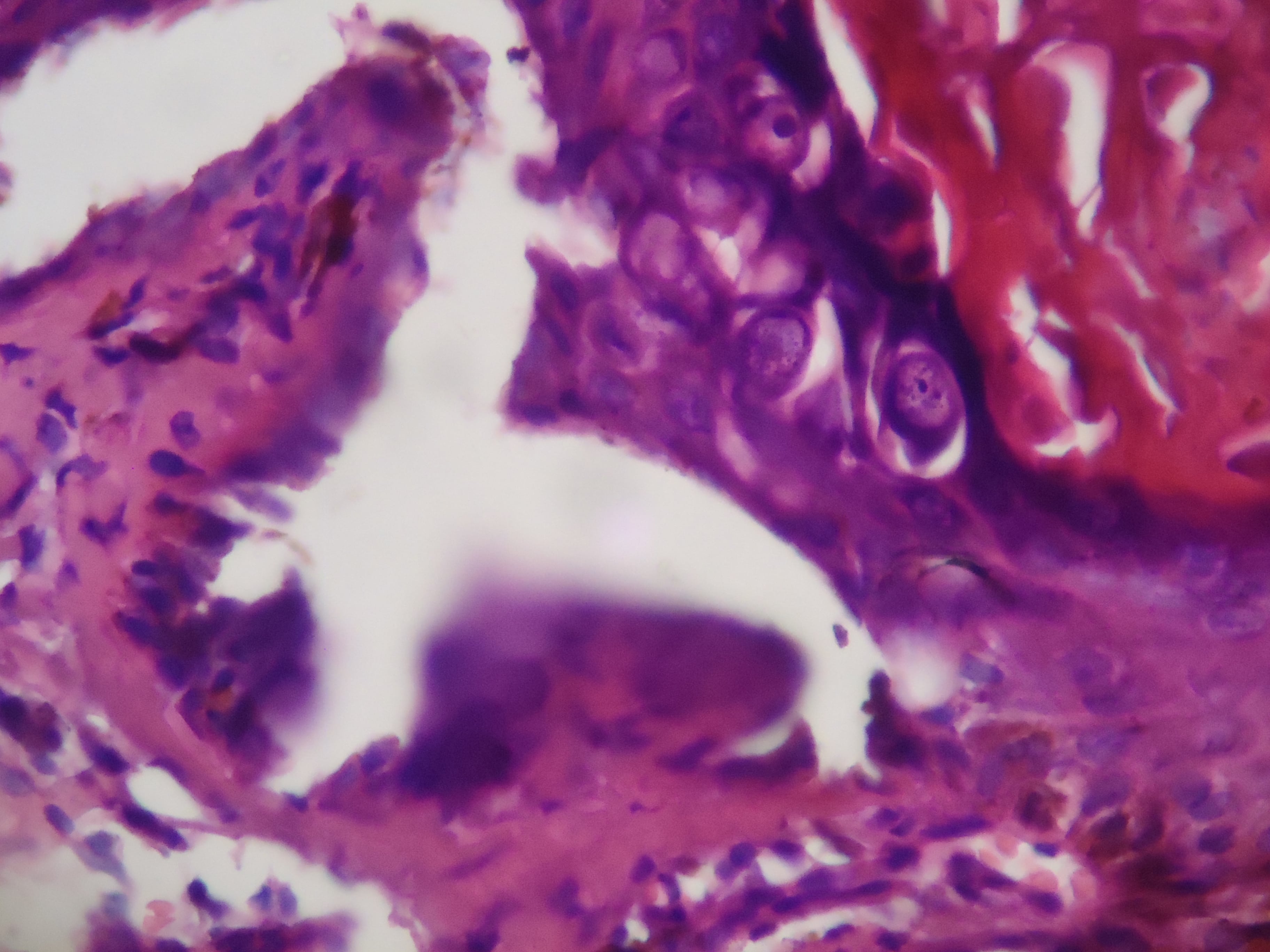 ENFEREMEDAD DE DARIER - HISTOPATOLOGIA