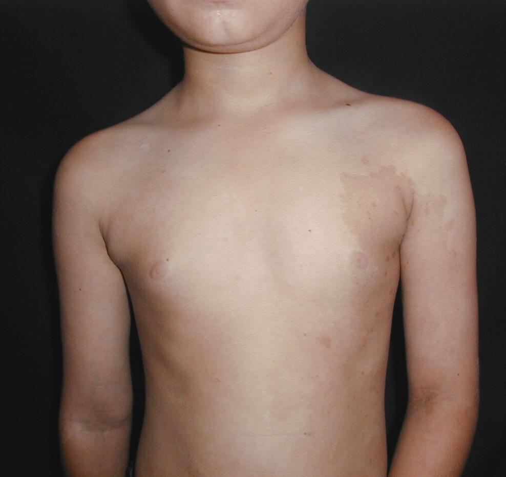 NEUROFIBROMATOSIS MULTIPLE - MANCHAS CAFE CON LECHE
