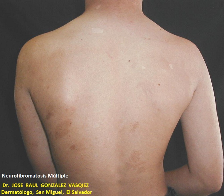 NEUROFIBROMATOSIS MULTIPLE - MANCHAS CAFE CON LECHE