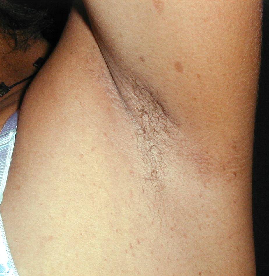 NEUROFIBROMATOSIS MULTIPLE - MANCHAS CAFE CON LECHE