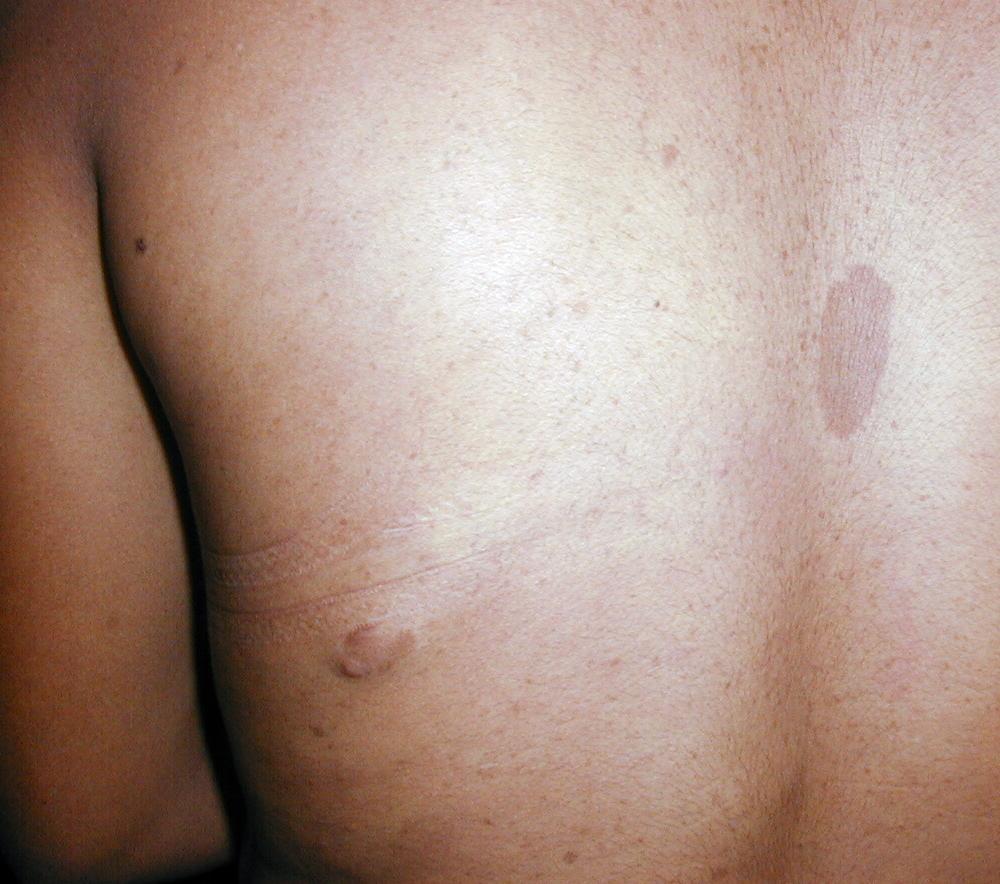 NEUROFIBROMATOSIS MULTIPLE - MANCHAS CAFE CON LECHE
