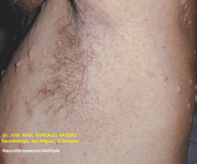 NEUROFIBROMATOSIS MULTIPLE - NEUROFIBROMASN LECHE