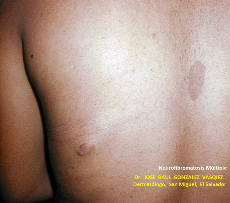NEUROFIBROMATOSIS MULTIPLE - NEUROFIBROMASN LECHE