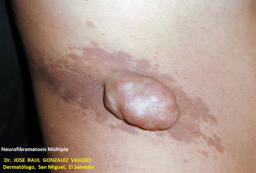 NEUROFIBROMATOSIS MULTIPLE - NEUROFIBROMASN LECHE