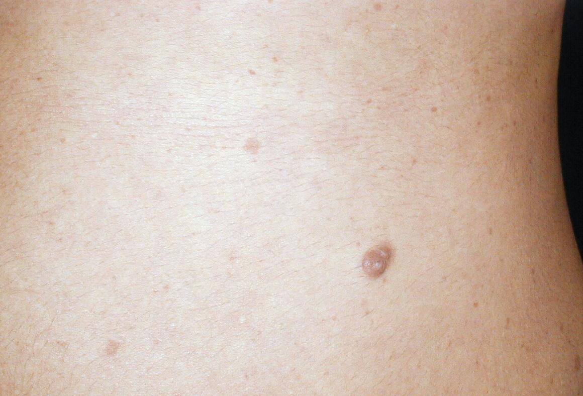 NEUROFIBROMATOSIS MULTIPLE - NEUROFIBROMASN LECHE