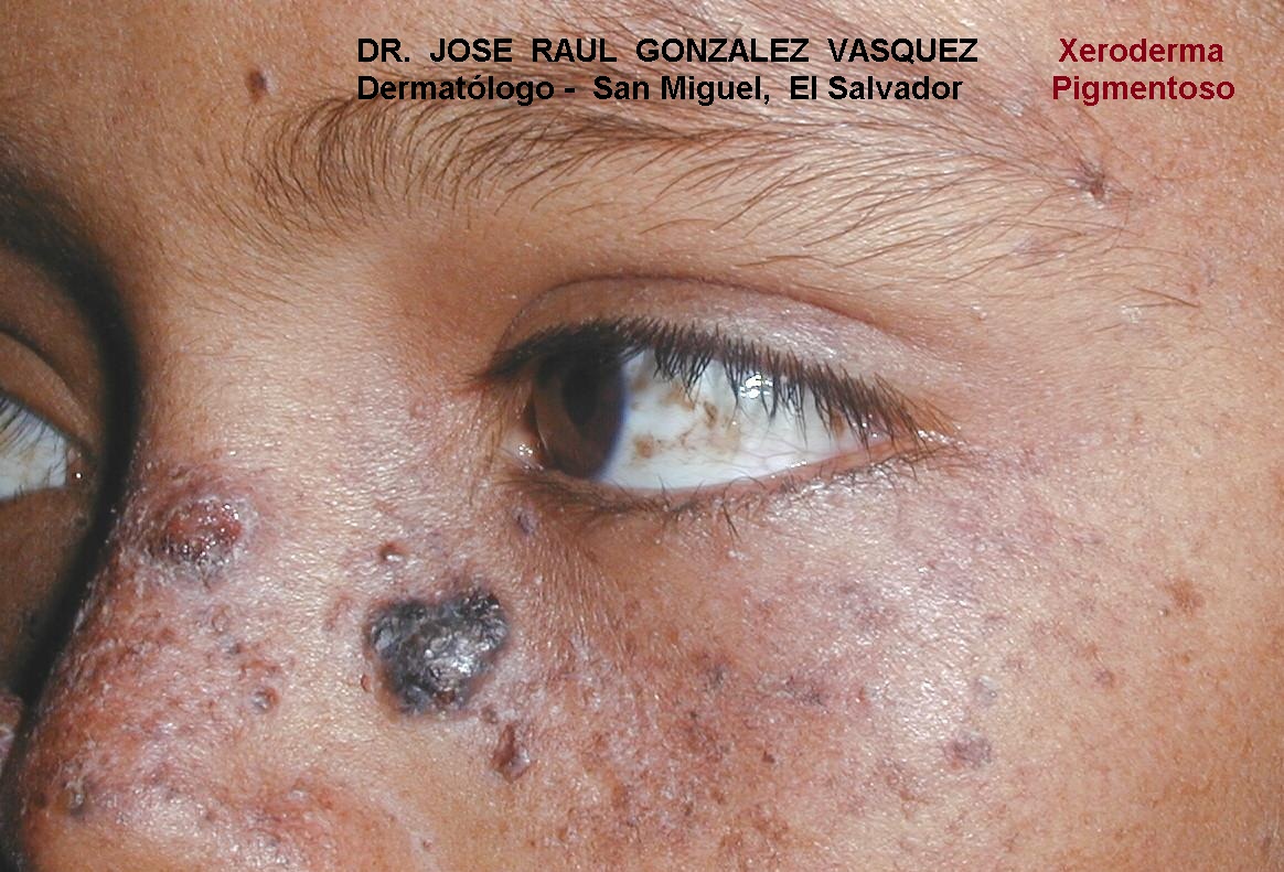 XERODERMA PIGMENTOSO
