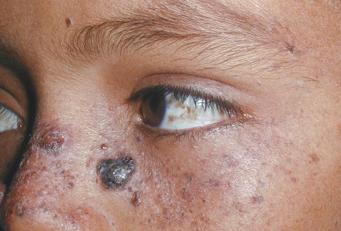 XERODERMA PIGMENTOSO - HERMANOS