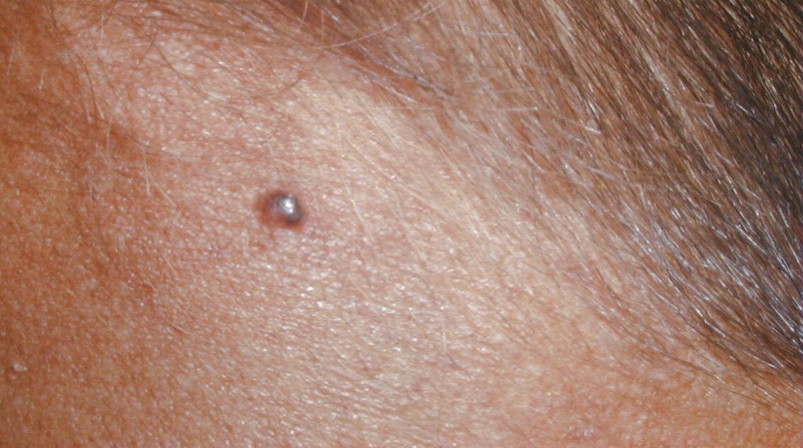 XERODERMA PIGMENTOSO - HERMANOS