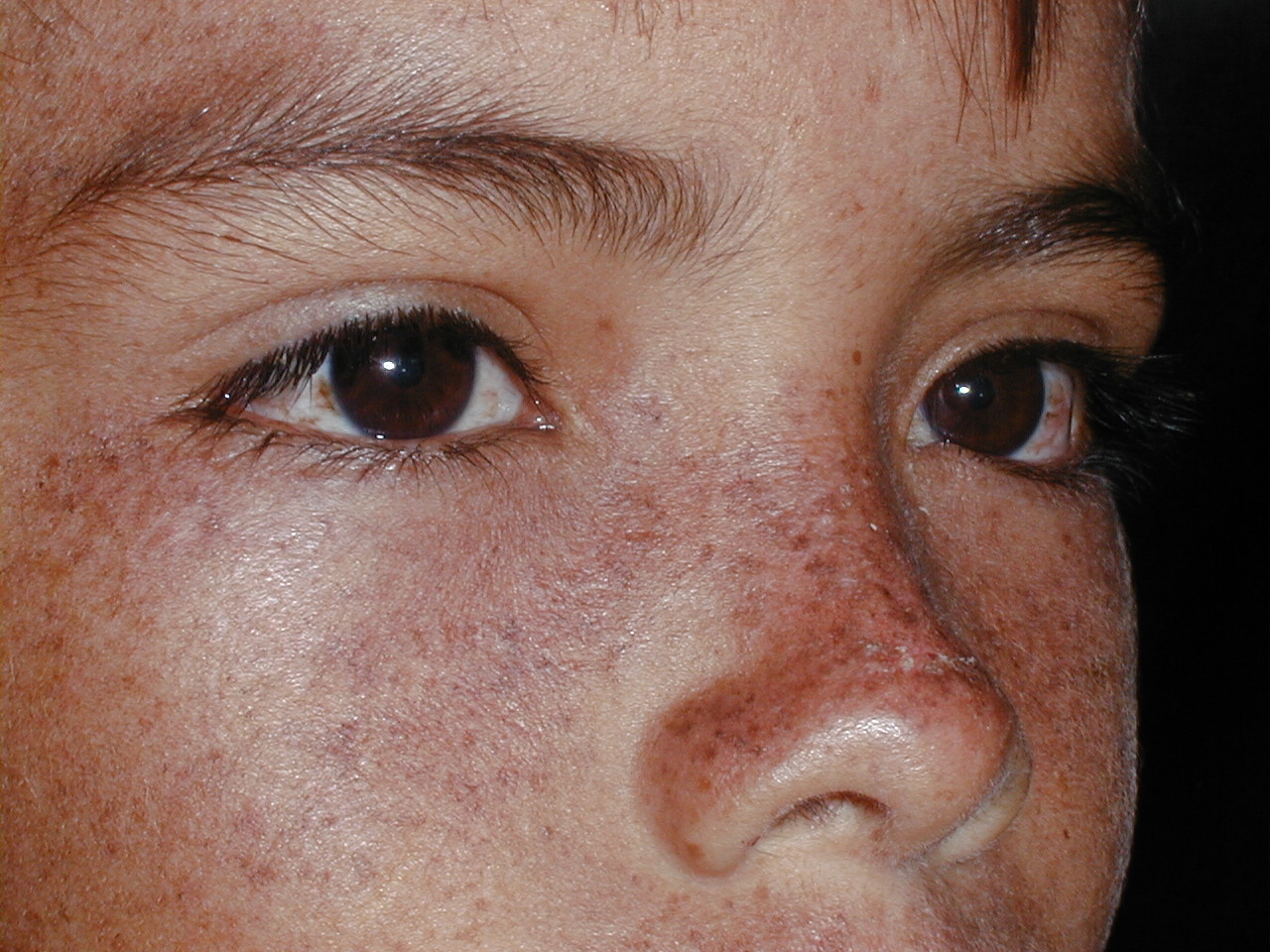 XERODERMA PIGMENTOSO - HERMANOS