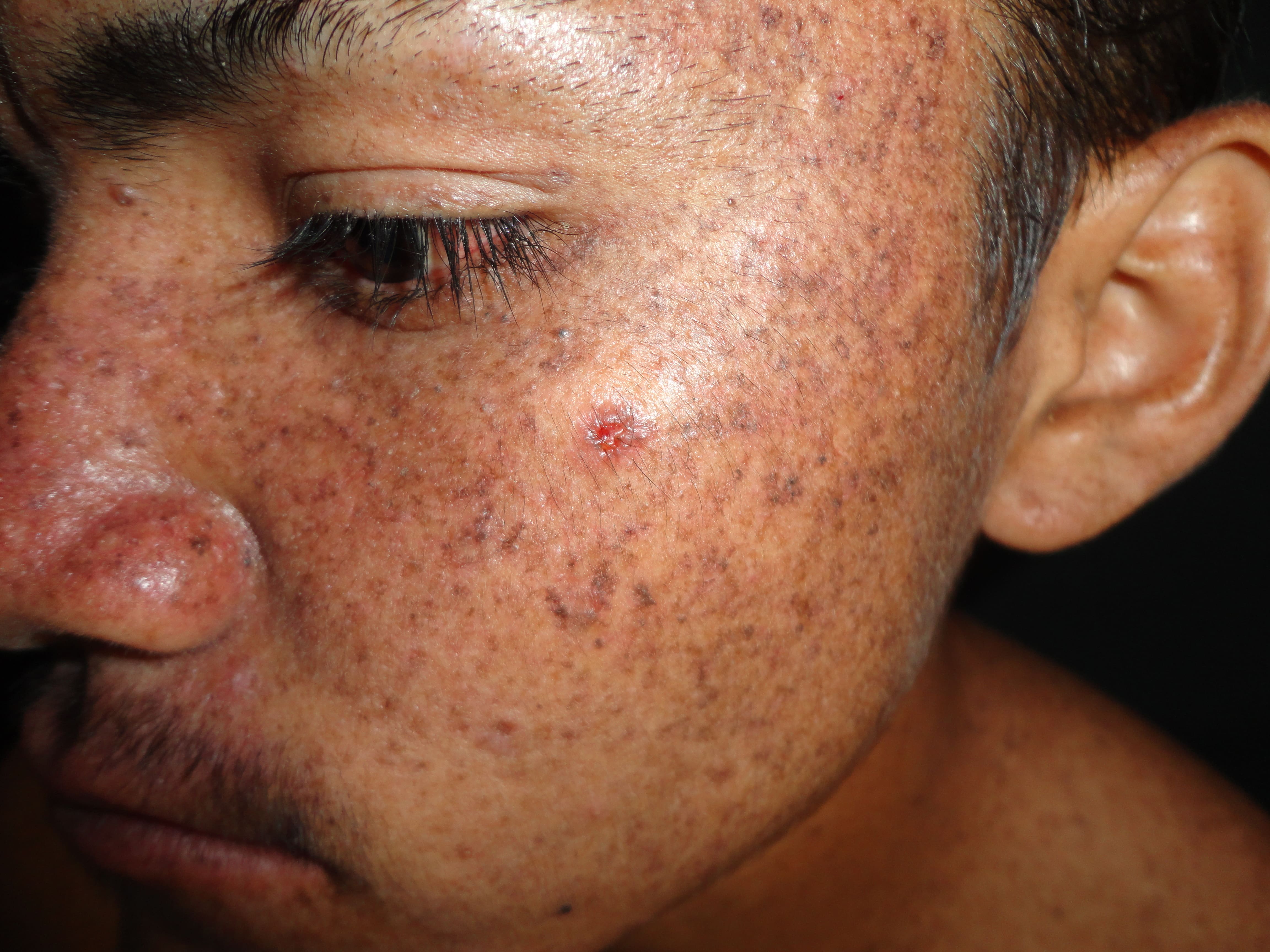 XERODERMA PIGMENTOSO