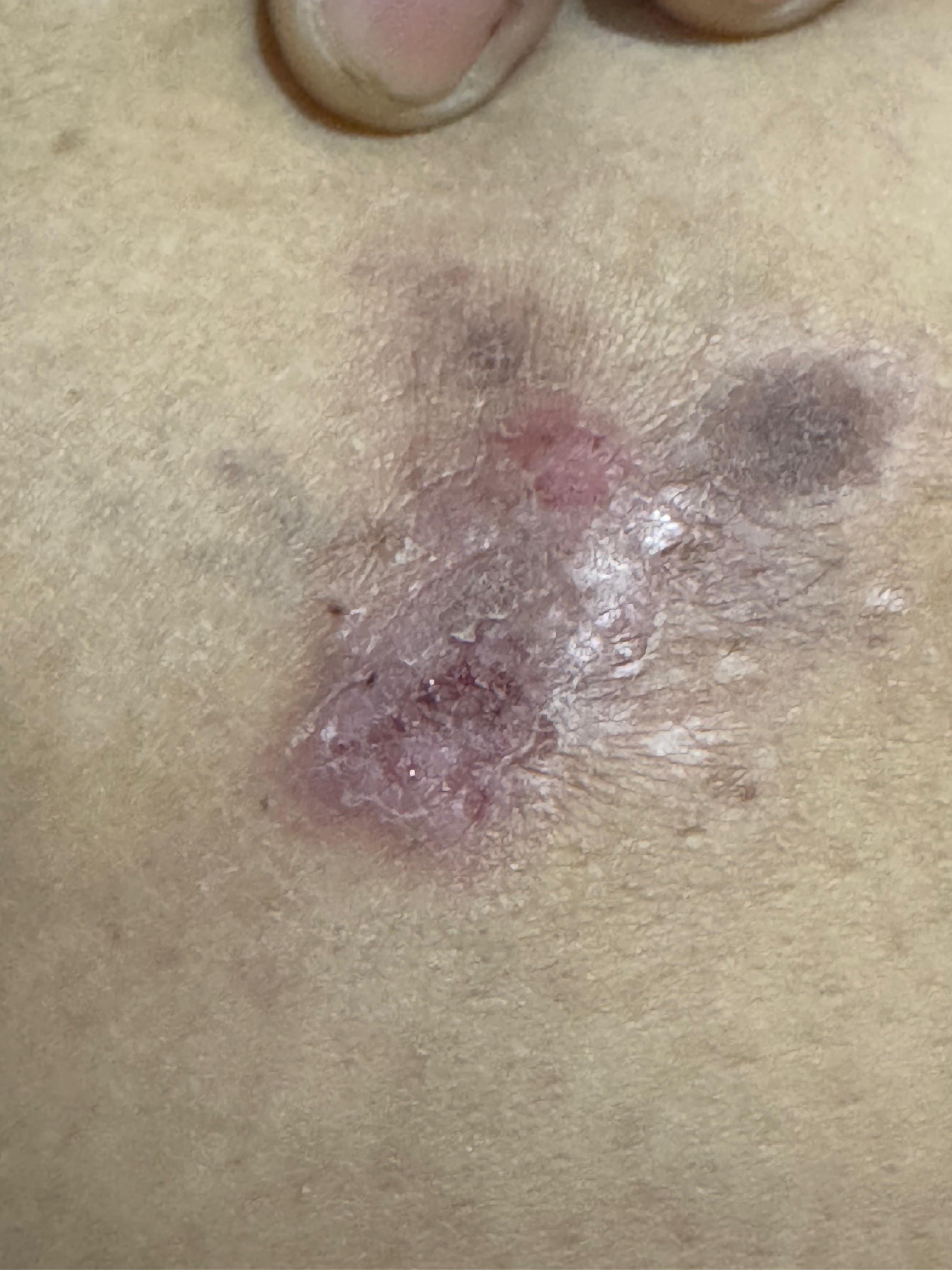 NEURODERMATITIS